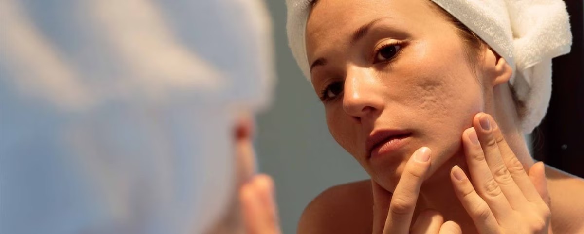 Unmasking the Truth: The Pivotal Role of Amoxicillin in Acne Treatment, as Explained by Dermatologists